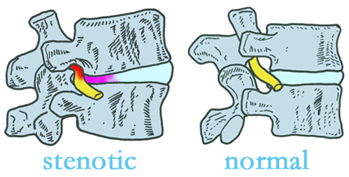 Williamson stenotic and normal spinal discs